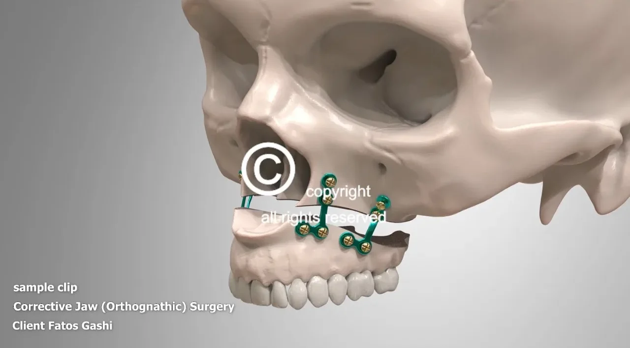 Corrective Jaw Surgery Orthognathic Animation