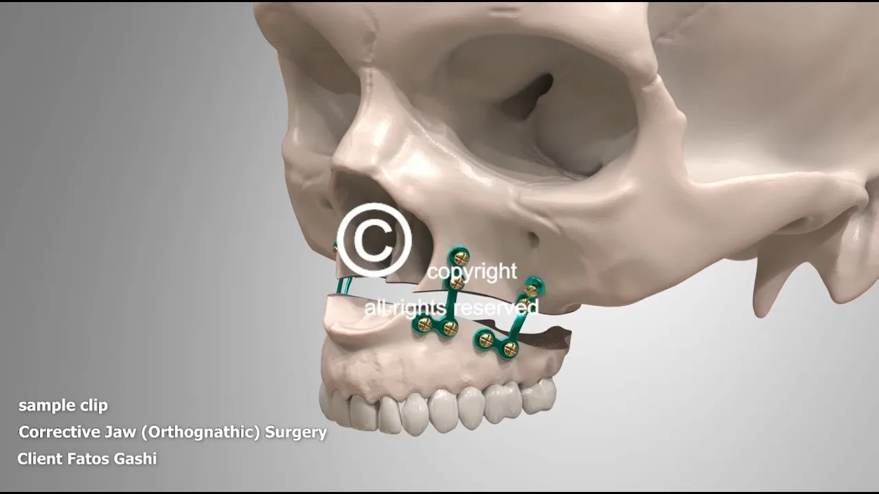 Corrective Jaw Surgery Orthognathic Animation