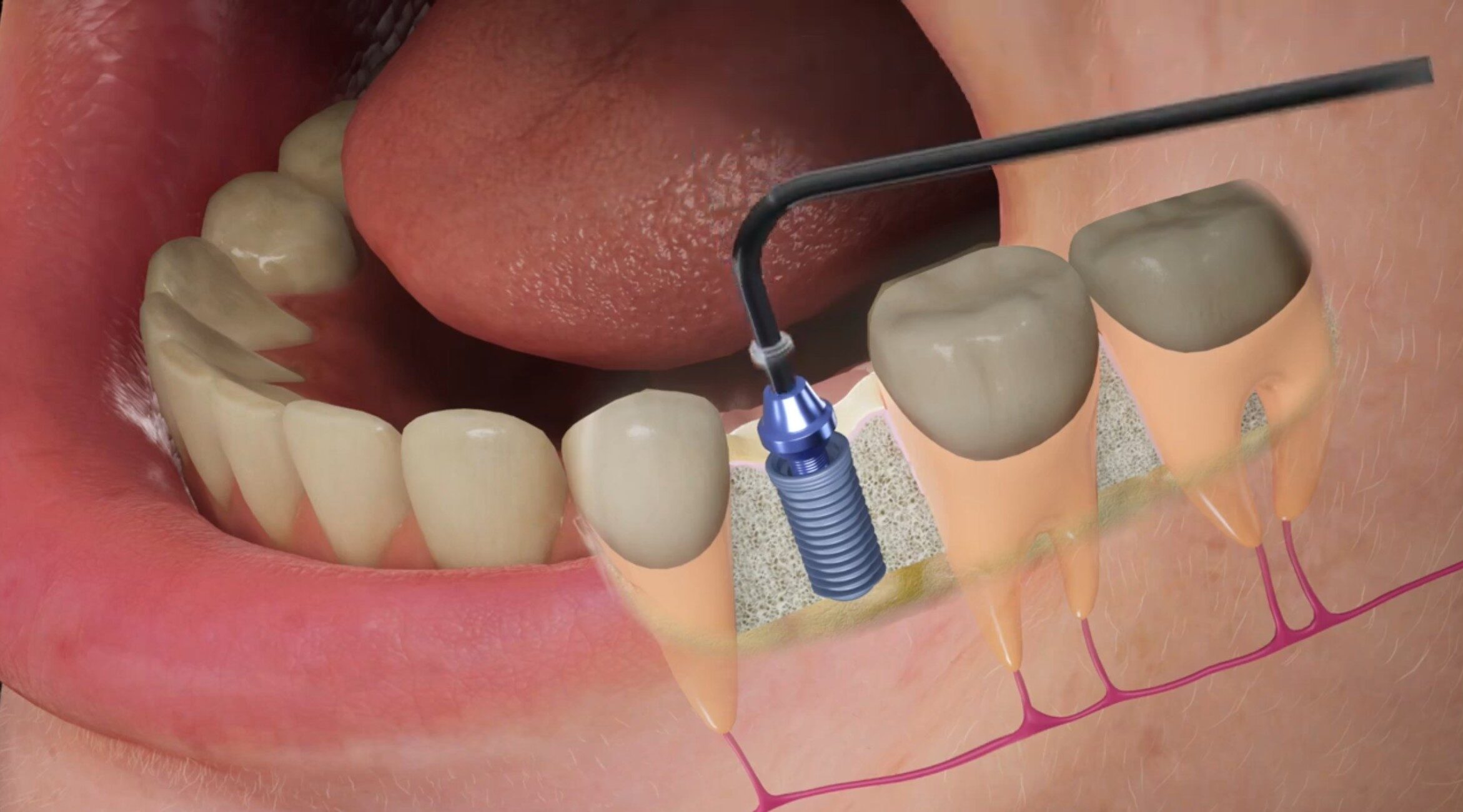 root canal treatment