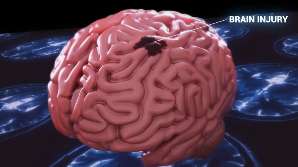 brain injury 3d animation