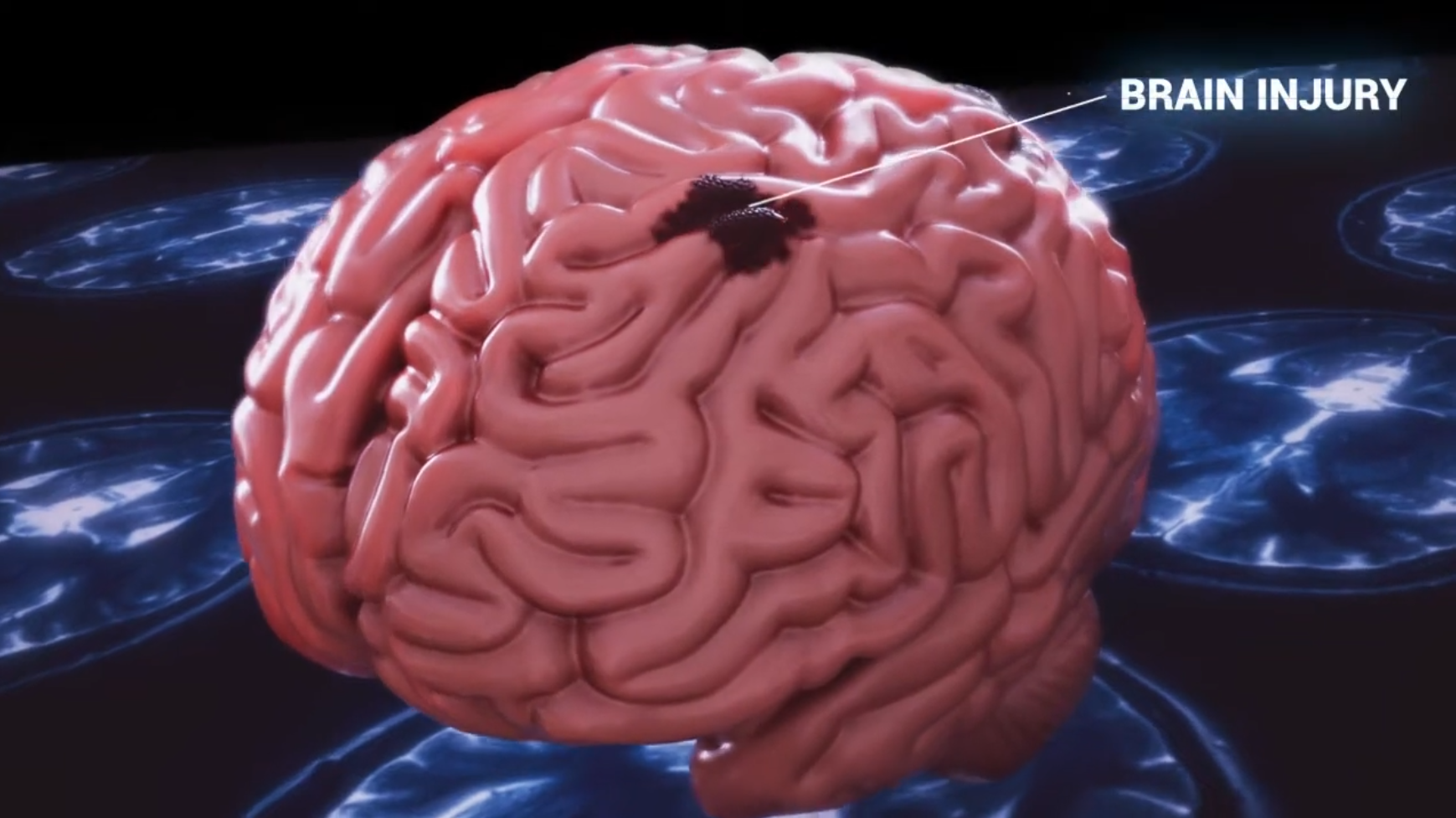 Traumatic brain injury animation